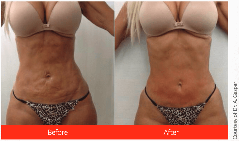 Body Sculpting Treatment: What To Do Before and After A Procedure